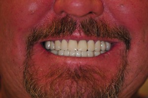After (Lower Titanium implants with Bonegarft & EMAX crowns)