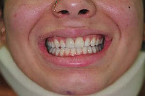After (emax veneer tooth nos. 11 and 21)