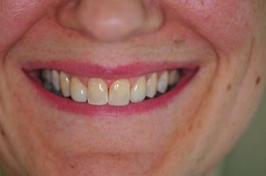 after (Upper EMAX CROWNS on teeth#s 12 & 22 )