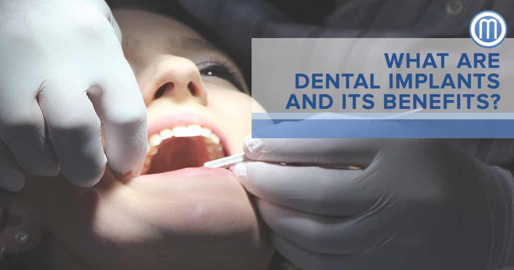 What Are Dental Implants And Its Benefits? Dr Rowena Marzo Esthetic